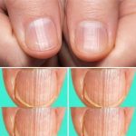 Rippled fingernails reveal secrets of possible disease