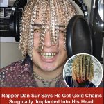 Rapper had surgery to get gold chains implanted into his skull